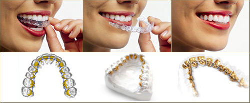Orthodontist İstanbul, invisalign İstanbul, orthodontist maslak, orthodontist esentepe, clear braces İstanbul, orthodontist tarabya, orthodontist etiler, orthodontist ulus